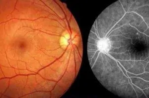 RETINOGRAFIA FLUORESCENTE (Angiofluoresceinografia)