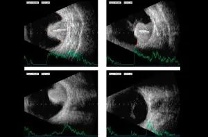 ULTRASSONOGRAFIA | ECOGRAFIA OCULAR