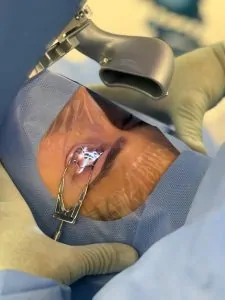 REFRATIVA | Trans-PRK