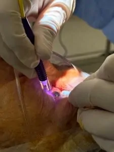 CICLOTERAPIA ANTIGLAUCOMATOSA