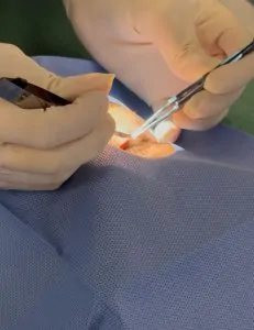 RESSECÇÃO DE TUMORES PALPEBRAIS