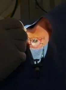 IMPLANTE SECUNDÁRIO DE LENTE INTRAOCULAR