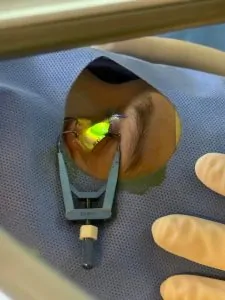 CROSSLINKING CORNEANO